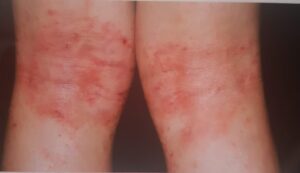 atopic dermatitis