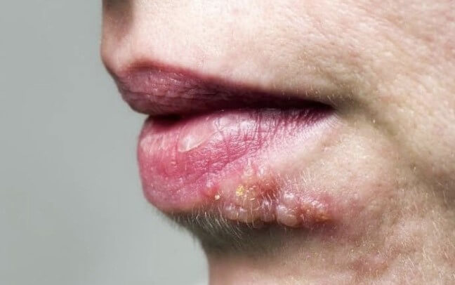 herpes virus lip